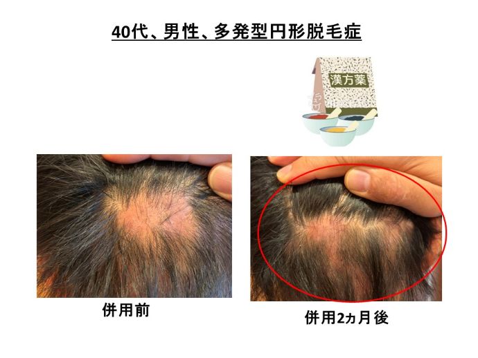 円形脱毛症　病院